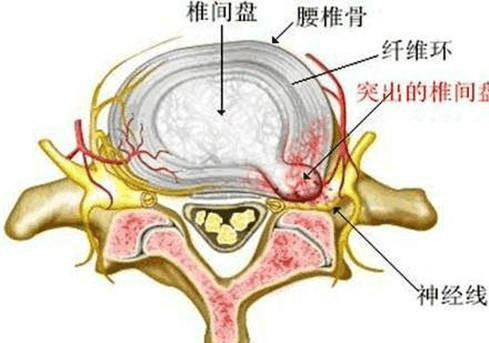 腰椎間盤(pán)突出癥的最新研究進(jìn)展與治療策略綜述